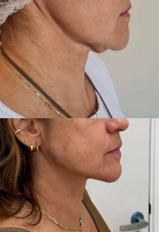 Antes e depois do contorno da mandíbula com bioestimulador de colágeno e preenchimento